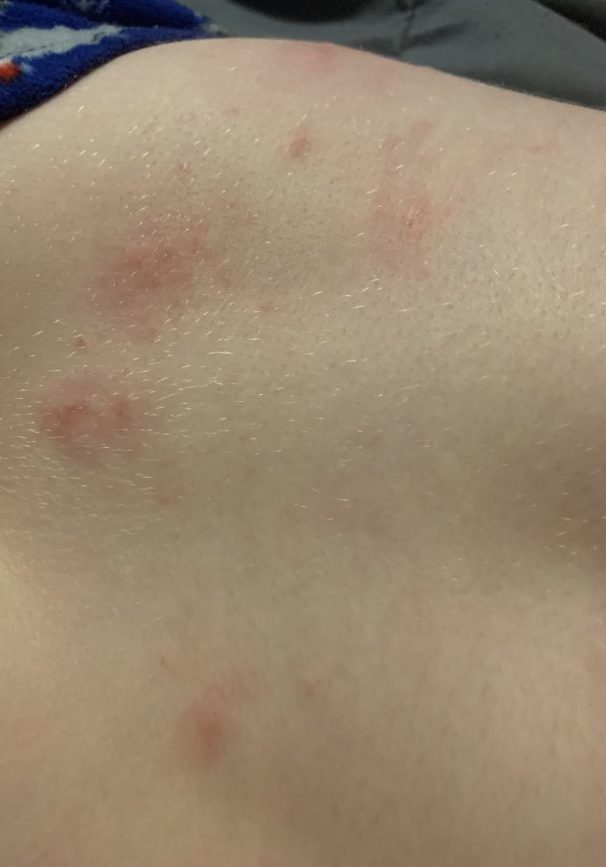 a child's back with red scaly patches of eczema 